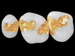 gold inlays