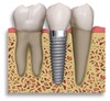 Dental implants