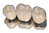 Dental bridges