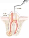 Root canal
