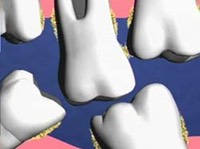 Sequelae to leaving a missing tooth