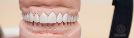 Wax Up for Smile Design