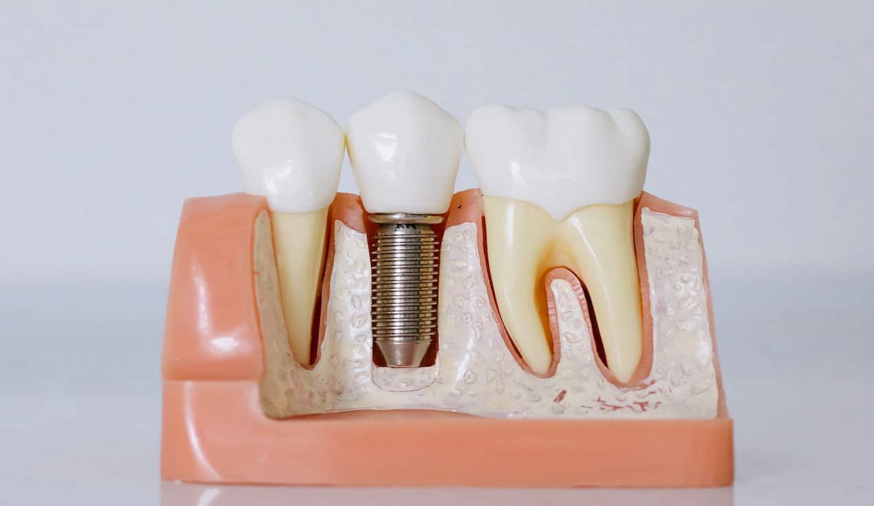 Dental Implant Wellington