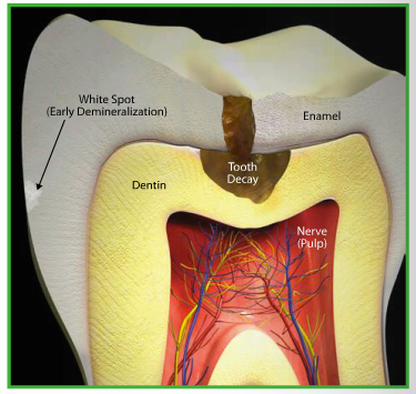 tooth decay