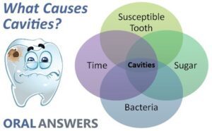 cause_of_cavities_tooth