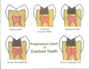 fractured-tooth-illustration