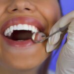 Prevent decay with fissure sealants