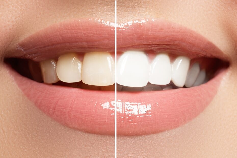 Yellow teeth can make a huge difference to your smile.