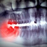3 signs you need to get your wisdom teeth removed