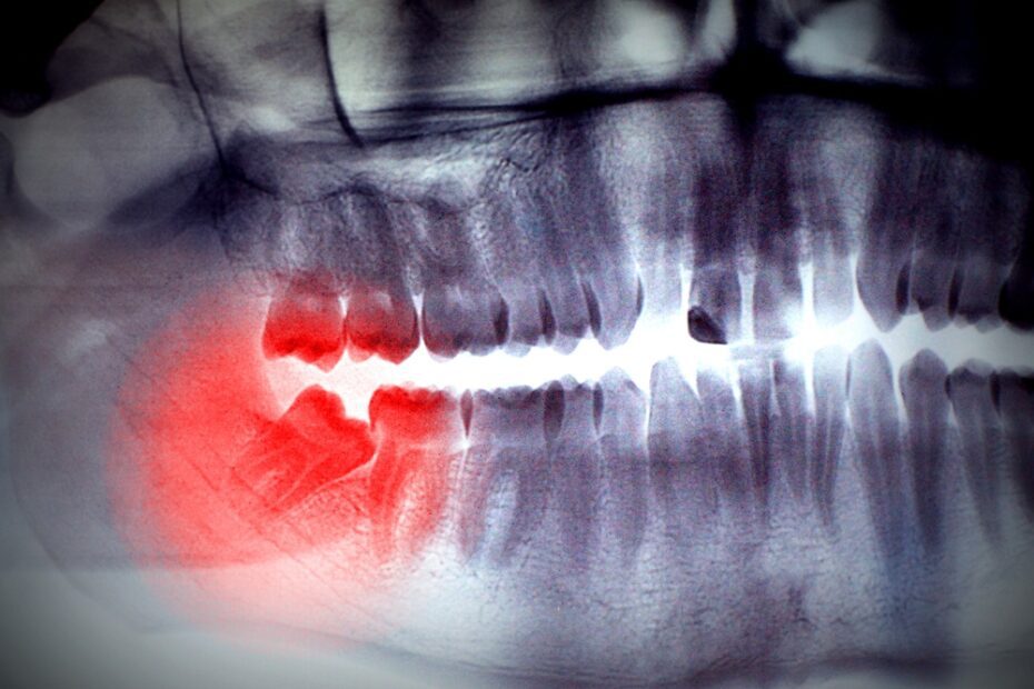 See your dentist to find out for sure whether your wisdom teeth need to come out.