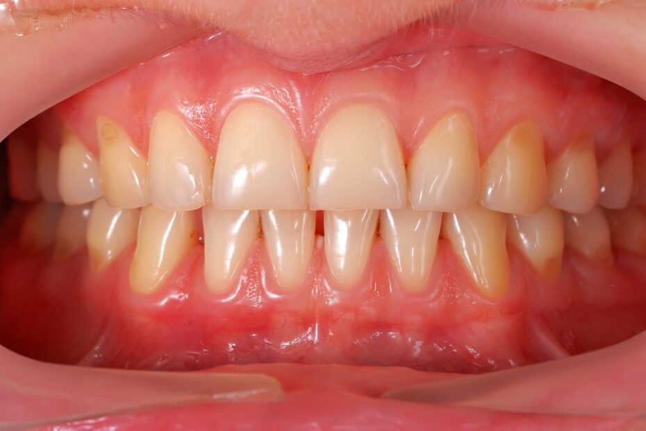 Gum disease has a range of causes that you should be aware of to aid prevention.