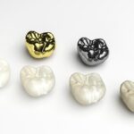 What is a composite dental filling?