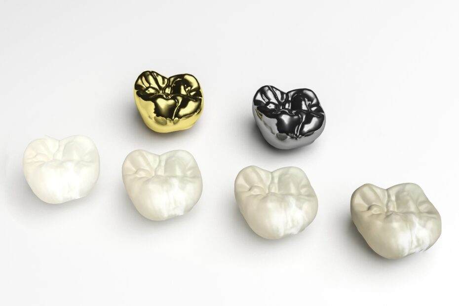 Ceramic, porcelain, metal - what's the difference between these dental crown materials?