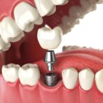It's essential to protect your new dental implant.
