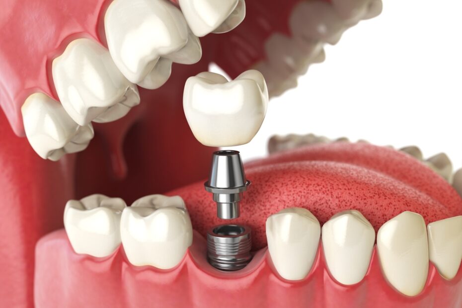 It's essential to protect your new dental implant.