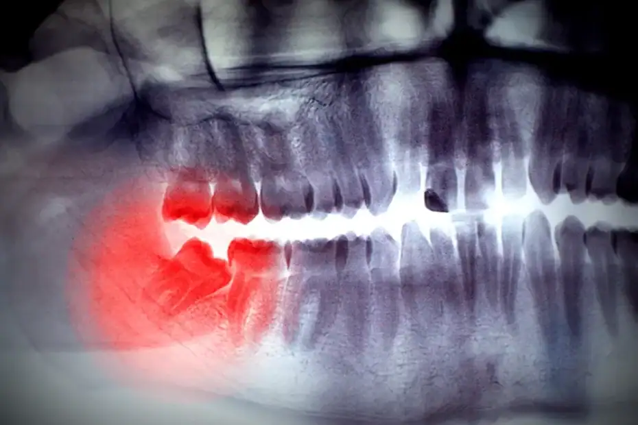 There’s no fixed age that determines when to remove wisdom teeth, but leaving them in too long can lead to serious problems down the road.