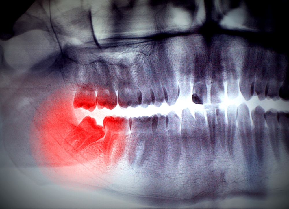 How Long Can You Leave Your Wisdom Teeth In And What Are The Consequences City Dentists Wellington How Long Can You Leave Your Wisdom Teeth In And What Are The Consequences City Dentists Wellington