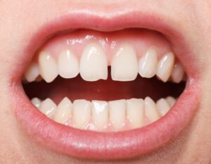 A diastema is a gap or space which develops between typically the two upper front teeth. Read on for options for treatment type and filling materials for closing a diastema.