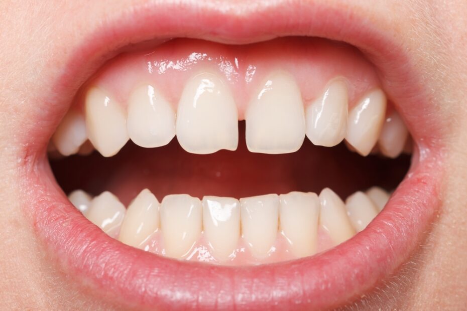 A diastema is a gap or space which develops between typically the two upper front teeth. Read on for options for treatment type and filling materials for closing a diastema.