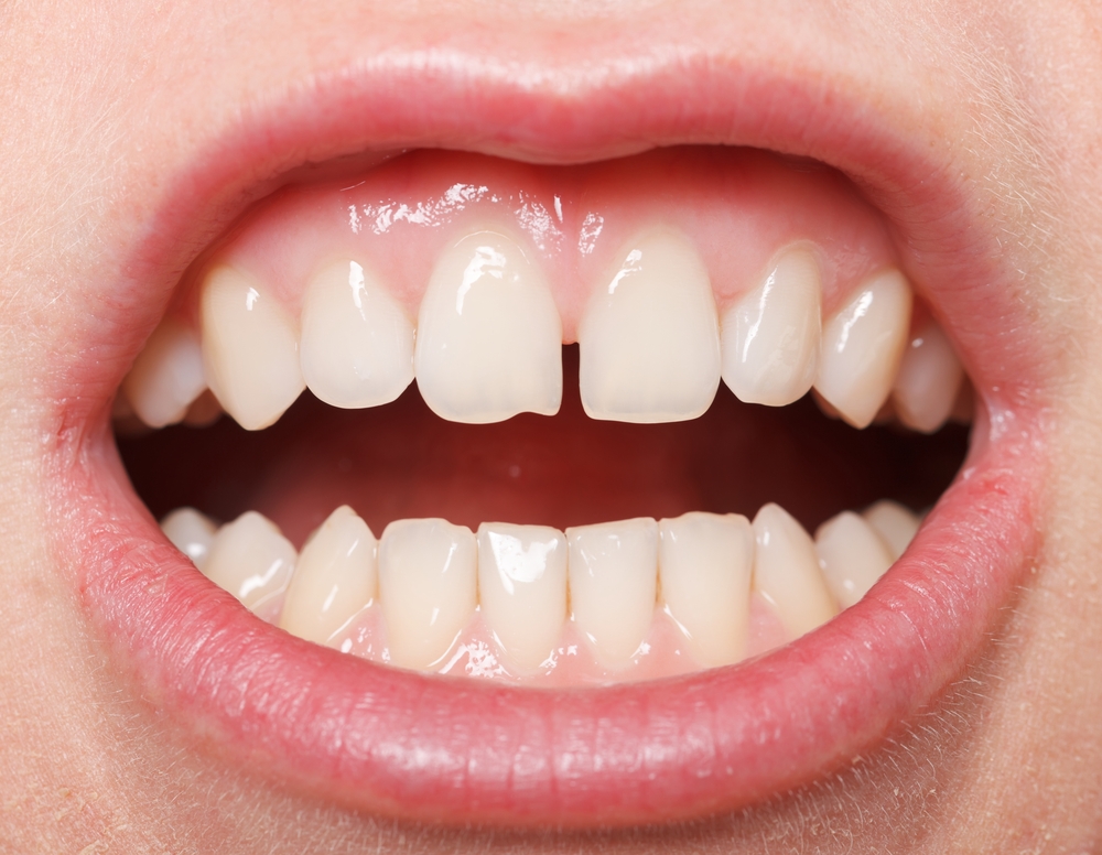 Options To Close A Diastema
