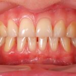 Risk factors in gum disease: Are you at a higher risk for gum disease?
