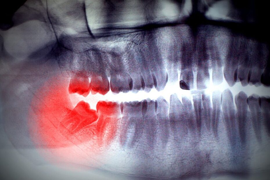 If wisdom teeth grow in at the wrong angle and aren't removed, it can lead to serious pain.