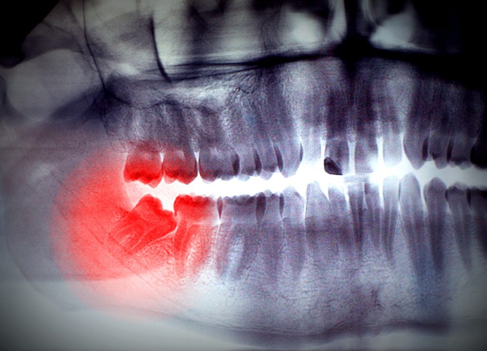 If wisdom teeth grow in at the wrong angle and aren't removed, it can lead to serious pain.