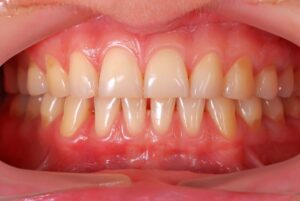 Healthy gums should appear pink to a very light red.