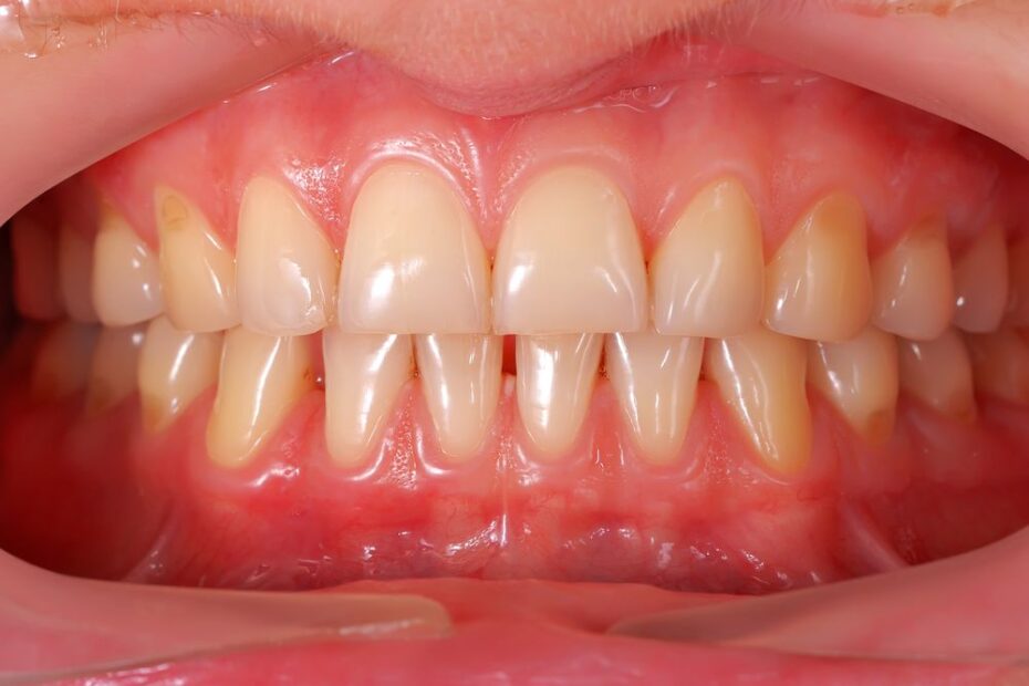 Healthy gums should appear pink to a very light red.