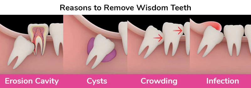 Reasons to remove wisdom teeth